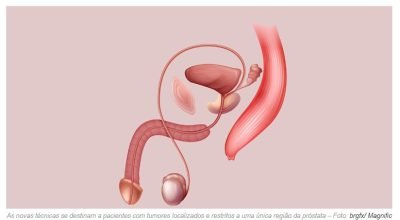 cancer de prostata