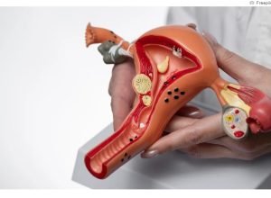 síndrome do ovário policístico