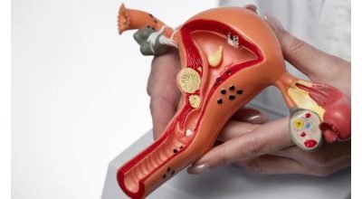 síndrome do ovário policístico